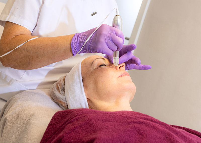 micro needling-2