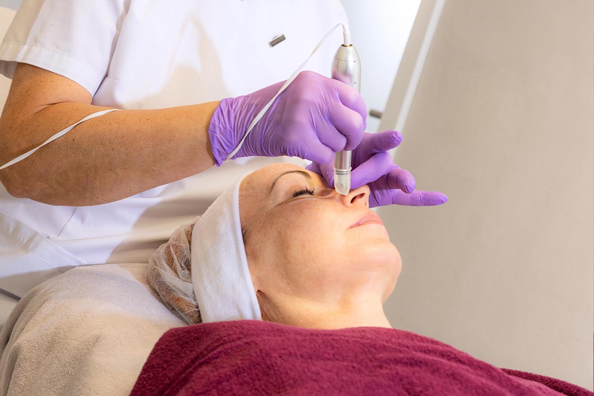 micro needling