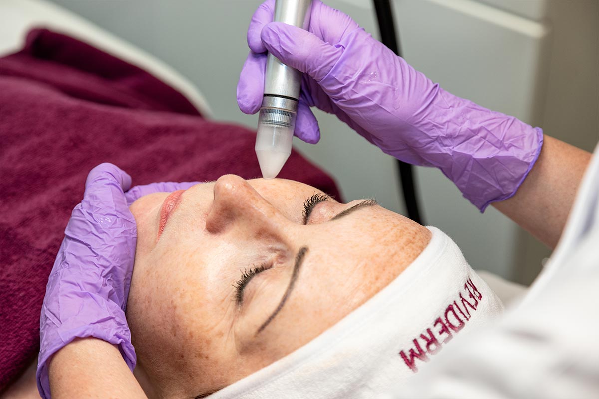 mikrodermabrasion